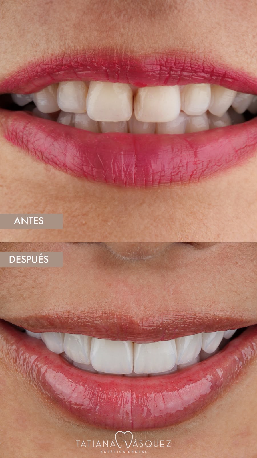 diseño de sonrisa en cerámica Medellín